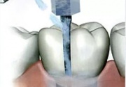 Профессиональная гигиена полости рта + Вектор-терапия